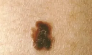 Ung thư da khởi phát âm thầm từ chấm đen gan bàn chân Ung thư da khởi phát âm thầm từ chấm đen gan bàn chân