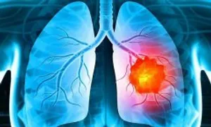 5 loại ung thư phổ biến ở nam giới 5 loại ung thư phổ biến ở nam giới