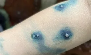Bôi nước cây nhọ nồi có trị được thủy đậu?