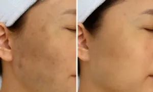 Hết đốm nâu trên mặt sau một năm điều trị Hết đốm nâu trên mặt sau một năm điều trị